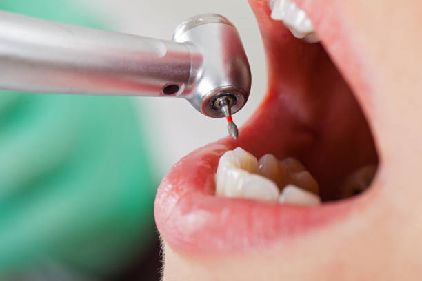 Best Emergency Wisdom Teeth Removal in Myers Corner, NY